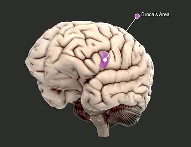 Damage to Broca's Area causes Broca's Aphasia