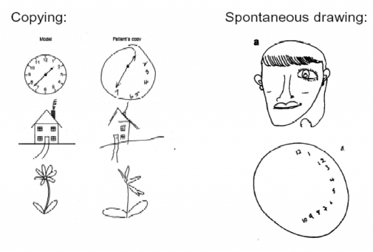 Left Neglect After Stroke - Definition & Treatment Exercises